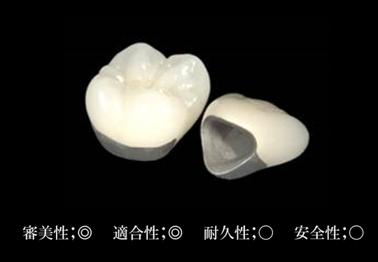 m*o様 銀歯/被せ物 銀歯はちょっと・・・被せ物の種類 - 浦安市の歯医者｜わかば