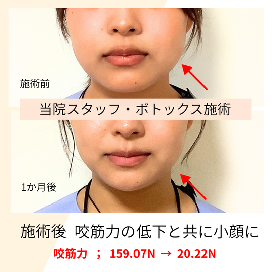 咬筋ボトックス - オリーブ歯科(安城市) 咬筋ボトックス - オリーブ歯科(安城市)