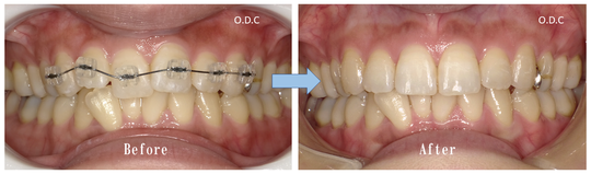 プチ矯正（部分矯正） - オリーブ歯科（安城市）