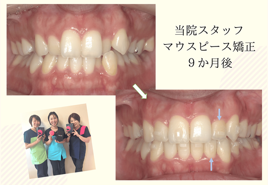 オブライエン クリスタル マウスピース Amazon.com: SOULWIT Cooling-Gel Ear Pads Cushions Replacement, for