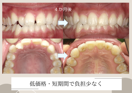 プチ矯正（部分矯正） - オリーブ歯科（安城市）
