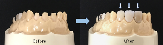 プチ矯正（部分矯正） - オリーブ歯科（安城市）